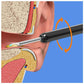 Earwax Removal Kit || مجموعة إزالة شمع الأذن